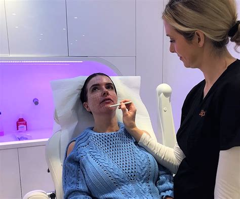 juvederm volite review